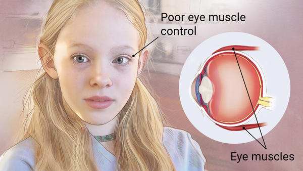 An example showcasing Strabismus