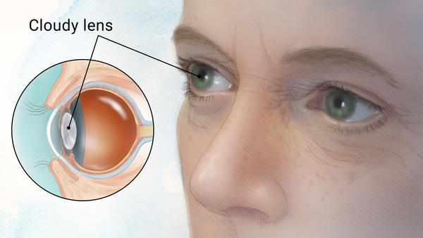 A diagram of cataracts